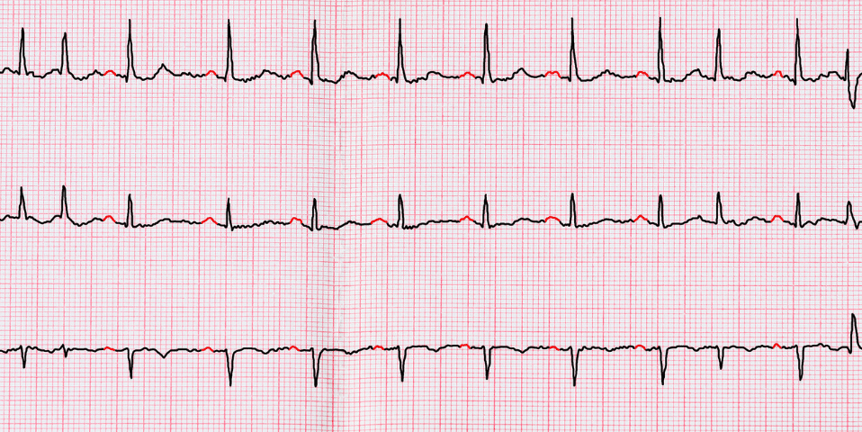 Atriumfibrilleren Gezondheidsplan - Uitgebreide Hartritme Management