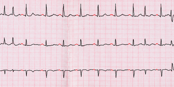 Atriumfibrilleren Gezondheidsplan - Uitgebreide Hartritme Management